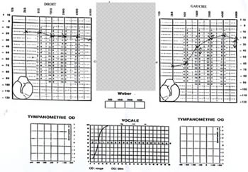 D�but de traitement pour retrouver l'audition